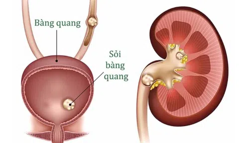 Sỏi bàng quang: Bệnh lý âm thầm dễ gây biến chứng nặng