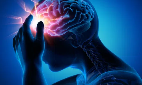 Dị dạng mạch máu não có nguy hiểm không?