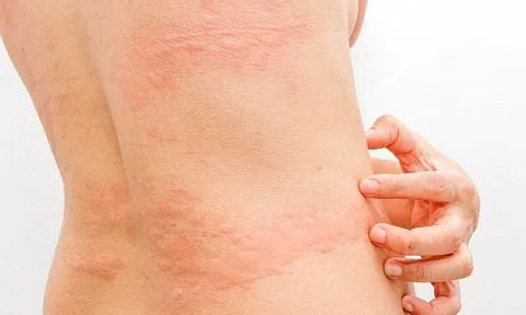 “Tôi đã từng nghĩ mình phải sống chung với bệnh mề đay suốt đời…”