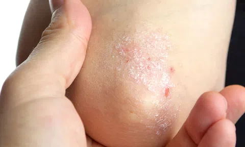 Chữa bệnh vảy nến thể giọt bằng thảo dược