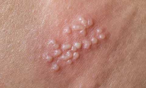 Nguyên nhân gây bệnh mụn rộp sinh dục