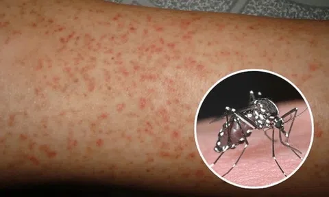 Hà Nội: Sốt xuất huyết đang trong thời kỳ cao điểm