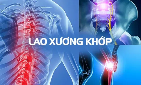 Ai là người dễ bị lao xương khớp?