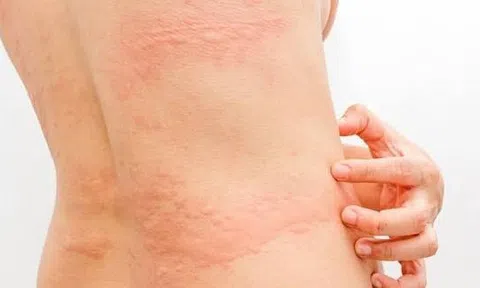 Nổi mề đay khi trời chuyển lạnh phải làm sao? Bật mí giải pháp hiệu quả từ YHCT