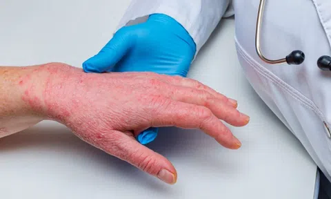 Bệnh viêm da cơ địa tăng nặng khi thời tiết lạnh, khô