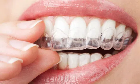 Niềng răng khểnh giá bao nhiêu?