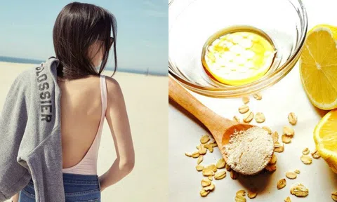 Học ngay 5 mẹo trị mụn lưng vừa an toàn vừa hiệu quả không ngờ