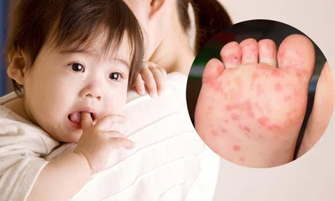 Những điều cha mẹ cần lưu ý khi chăm sóc trẻ mắc bệnh tay chân miệng