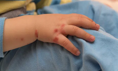 Cẩn thận với biến chứng của bệnh tay chân miệng ở trẻ em!