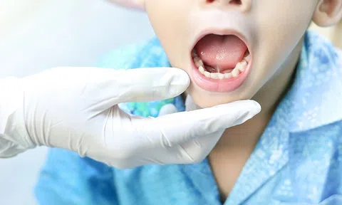 Dính thắng lưỡi: Thủ phạm khiến trẻ nói ngọng, khó phát âm