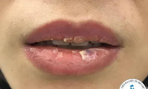 Cảnh báo nhiều bệnh nhân bị nhiễm trùng nặng do xăm hình