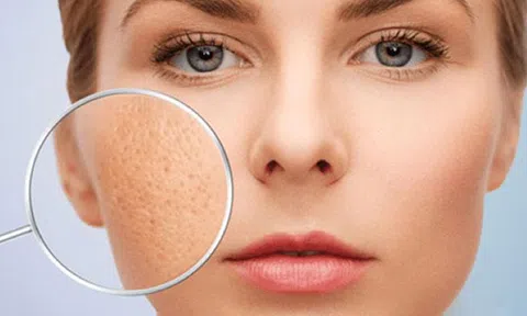 Chị em hết chật vật với việc làm sạch lỗ chân lông bằng những cách sau