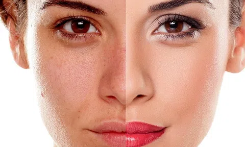 Qua 30 tuổi da xuống cấp nghiêm trọng, đen sạm và nhăn nheo phải làm sao?