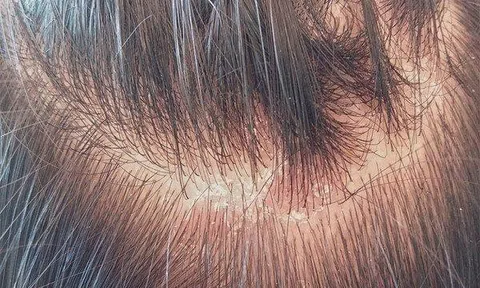 Cảnh báo những tác hại đáng sợ từ gàu? Cách trị gàu dứt điểm và an toàn tại nhà