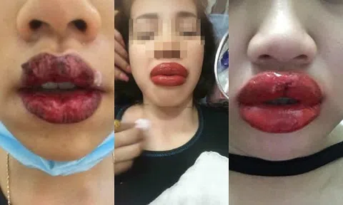 Những điều chị em cần lưu ý trước khi phun xăm môi để tránh rước họa vào thân