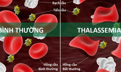 Nguyên nhân và triệu chứng của bệnh tan máu bẩm sinh