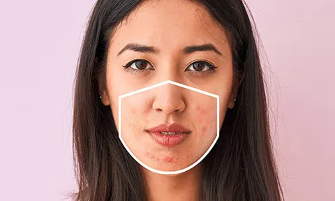 Bật mí bí kíp đeo khẩu trang để giảm mụn cho da nhạy cảm