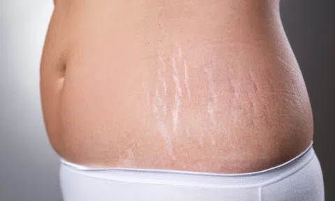 Bất ngờ: Điều trị vết rạn da đỏ nhanh nhất bằng công nghệ hiện đại 