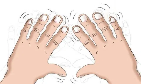 Run tay khó chữa - Giải pháp nào giúp người bệnh lấy lại tự tin trong cuộc sống?