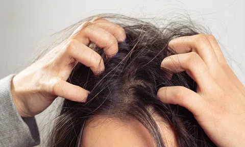 Cùng dầu gội gừng trị ngứa da đầu, tạm biệt gàu ngứa
