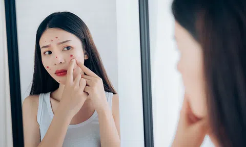 Hành trình giảm mụn trong 1 tháng của cô nàng công sở nhờ chọn đúng loại tẩy trang.