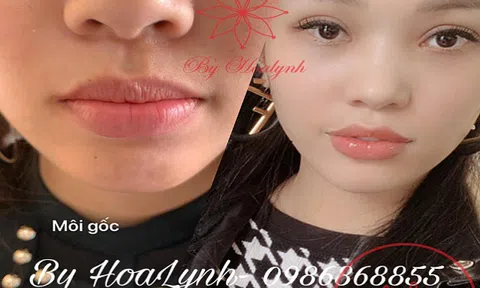 Tiêm filler có ảnh hưởng gì đến sức khỏe không?