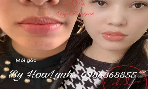 Tiêm Môi filler tại Orchard Group uy tín nhất hà nội