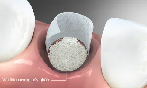 Nha Khoa trồng răng Implant miễn phí cấy ghép xương