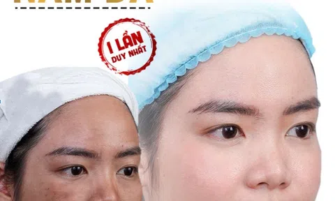 Thẩm mỹ viện rose điều trị nám hiệu quả an toàn nhất hà nội