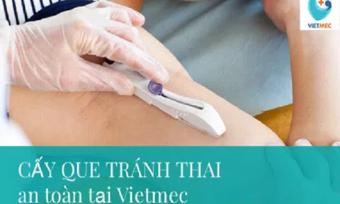 3 vấn đề chị em thường quan tâm về cấy que tránh thai