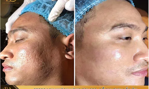 Thẩm mỹ viện Quốc tế Bắc Âu trị sẹo một lần duy nhất
