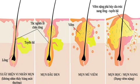 Tổng hợp các loại mụn thường dễ mắc phải