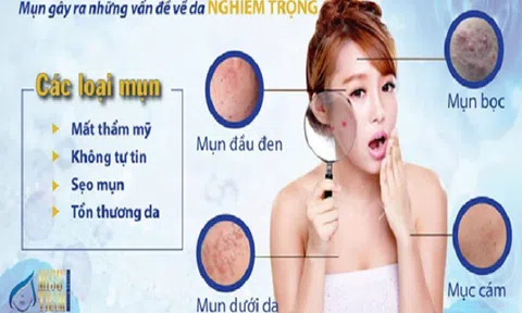 Điều trị mụn bằng công nghệ Laser CO2 Fractional tại TpHCM