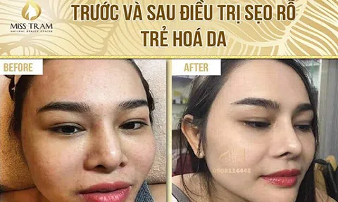 Công nghệ Laser CO2 Fractional chuyên trị Sẹo Rỗ - Rỗ Mụn hiệu quả TpHCM