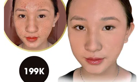 Thẩm mỹ viện Rose trị sẹo hiệu quả 1 lần duy nhất cam kết hiệu quả bằng văn bản