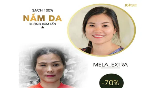 Thẩm mỹ viện Rose Cầu Giấy trị nám 1 lần duy nhất an toàn hiệu quả