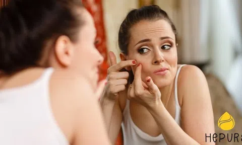 4 điều người bị mụn do nội tiết nên biết