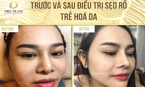 Lưu ý chăm sóc da đúng cách sau liệu trình laser