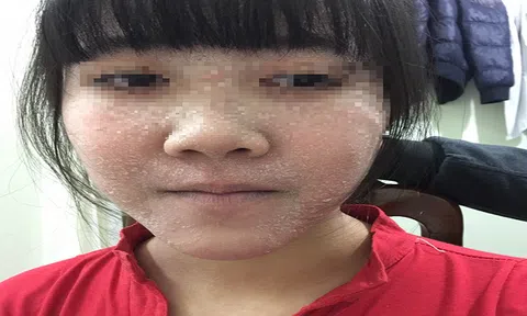 Tiết lộ bí quyết đánh bay viêm da cơ địa bằng Đông Y