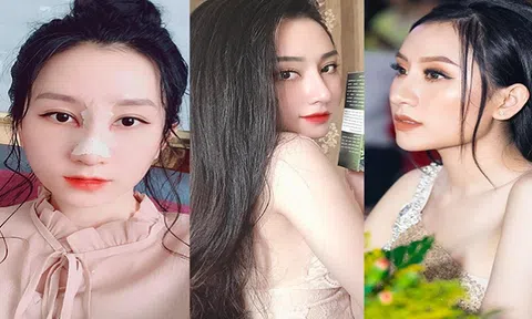 Nâng mũi theo phong thuỷ đang được ưa chuộng nhất hiện nay
