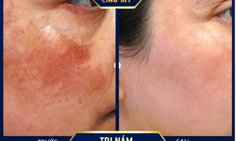 Điều trị nám bằng Laser picosure tại TMV Bắc Mỹ – Công nghệ trị nám tận gốc tiên tiến nhất năm 2020