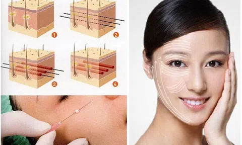 Nâng cơ mặt chảy xệ bằng chỉ Ultra V Lift không cần phẫu thuật tại TMV Quốc tế Bắc Mỹ Thanh Hoá