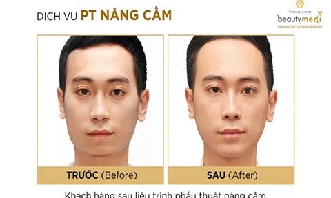 Khuôn mặt thanh tú nhờ sở hữu dáng cằm chuẩn tỷ lệ vàng