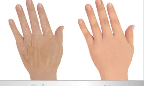Có nên tiêm filler ngón tay hay không?