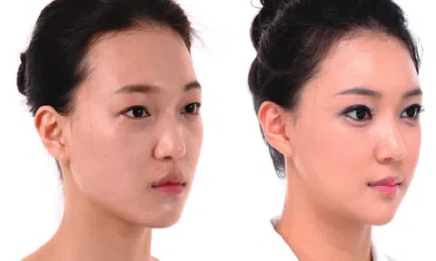 Đừng hiểu lầm bản chất của tiêm filler độn thái dương!