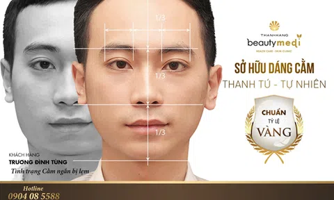 Cằm đẹp tự nhiên, không còn khuyết điểm