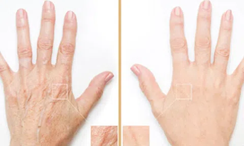 Tiêm filler bàn tay - lựa chọn vàng níu kéo tuổi xuân
