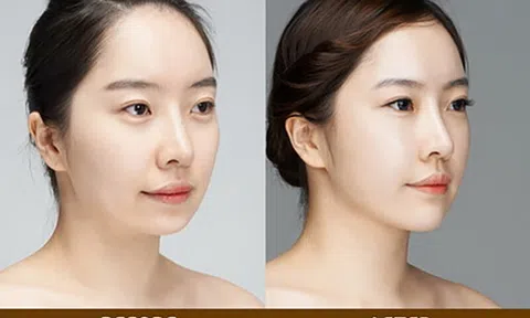 Tiêm filler đầu mũi – Khái niệm và ưu điểm