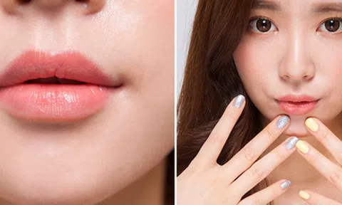 Tiêm filler khóe cười – xu hướng làm đẹp mới hiện nay