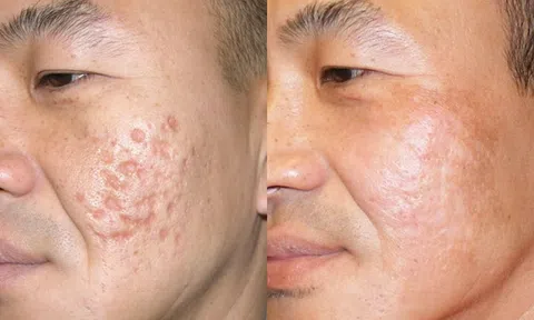 Làm đầy sẹo lõm bằng filler có an toàn không?